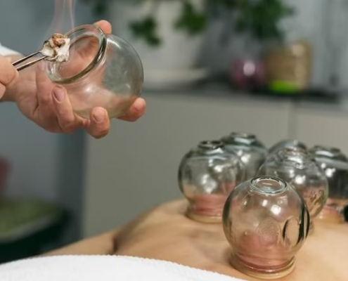 cupping