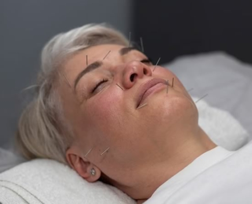 Ansigts akupunktur og skønhedsakupunktur