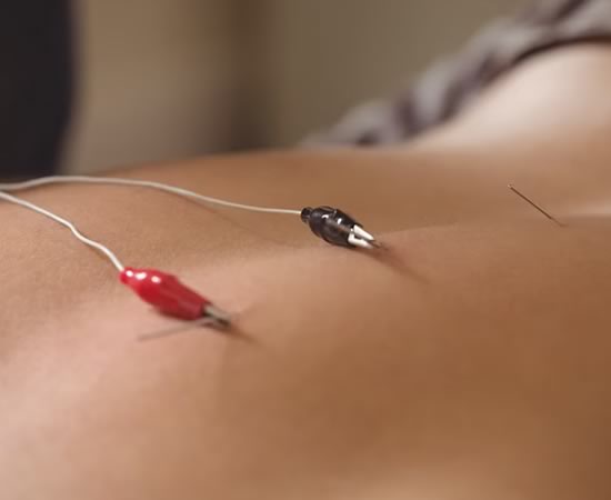 Elektro akupunktur